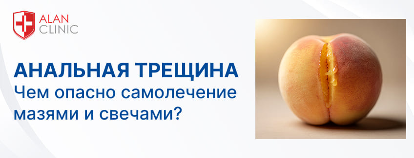 Анальная трещина – чем опасно самолечение мазями и свечами