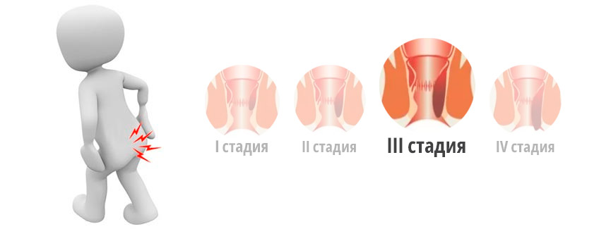 Геморрой третьей стадии (степени)