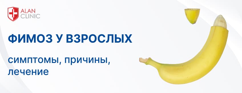 Фимоз у мужчин: симптомы, причины, лечение – когда срочно обратиться к урологу
