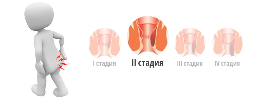  Геморрой второй стадии (степени)