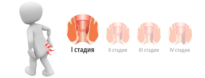 Геморрой первой стадии (степени)