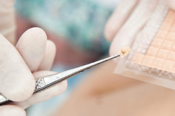 Рефлексотерапия