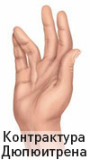 Контрактура Дюпюитрена