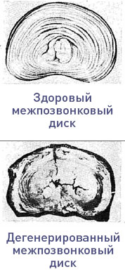 Позвоночная грыжа