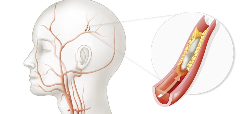 Заболевания в неврологии – сосудистые патологии