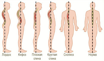 Нарушения осанки