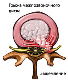 Межпозвоночная грыжа