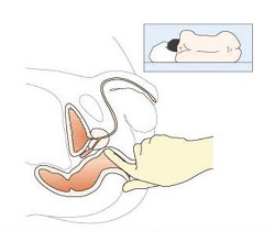 Массаж предстательной железы