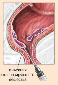 Склеротерапия при геморрое Склеротерапия при геморрое