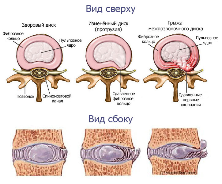 Заболевания позвоночника