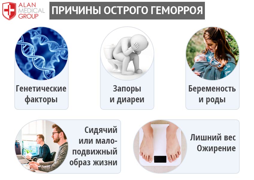 Причины острого геморроя