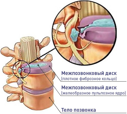 Грыжа позвоночника