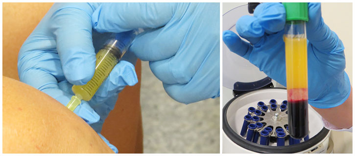 Плазмотерапия