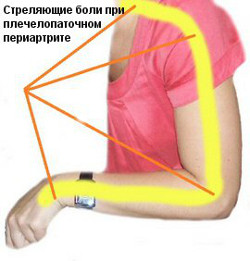 Симптомы плечелопаточного переартрита
