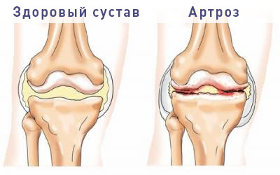 Артроз суставов. Симптомы, причины, виды, как лечить Артроз суставов. Симптомы, причины, виды, как лечить