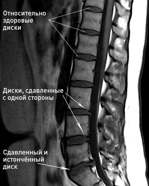 Остеохондроз на снимке МРТ